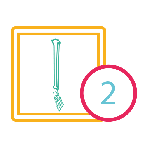 Pierna Ap. Lateral (Tibia y Perone) Bilateral